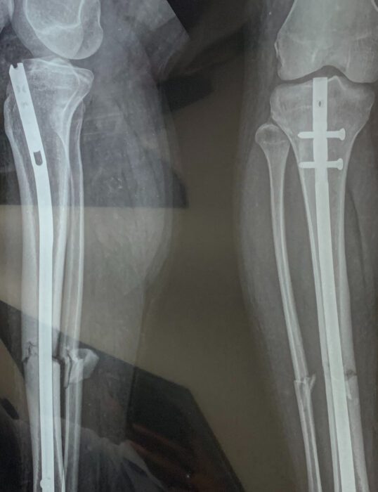 X-ray